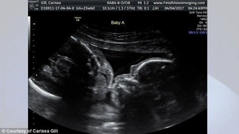 Megható ultrahang fotó: anyaméhben puszilkodnak az ikrek