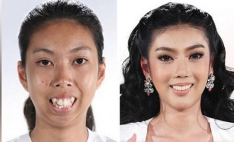 Csodaszép lett a thai lány, aki fődíjként nyert egy műtétet