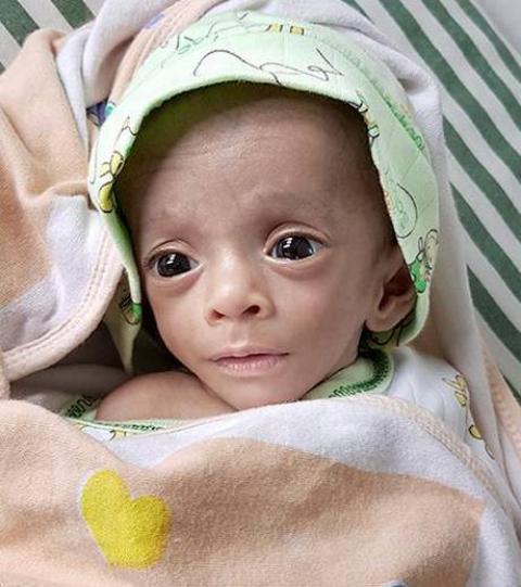 Csodababának tartják a 26 hétre született kislányt, aki túlélt egy műtétet is
