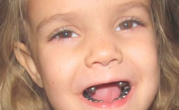Egy 4 éves kislány összes fogára ezüst koronát helyezett egy beteg orvos! Videó