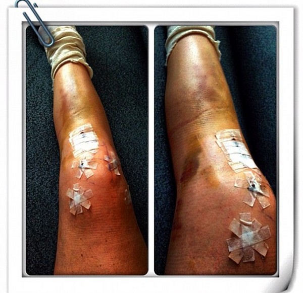 A súlyos balesetet szenvedett síelőnő megosztotta a műtét utáni képeit a lábáról