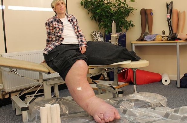 Egy nő, akinek a lábai egy betegség miatt 108 kg- ra nőttek!
