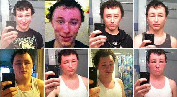 Súlyos allergiás reakciókat szenvedett el egy fiú a hajfestéktől
