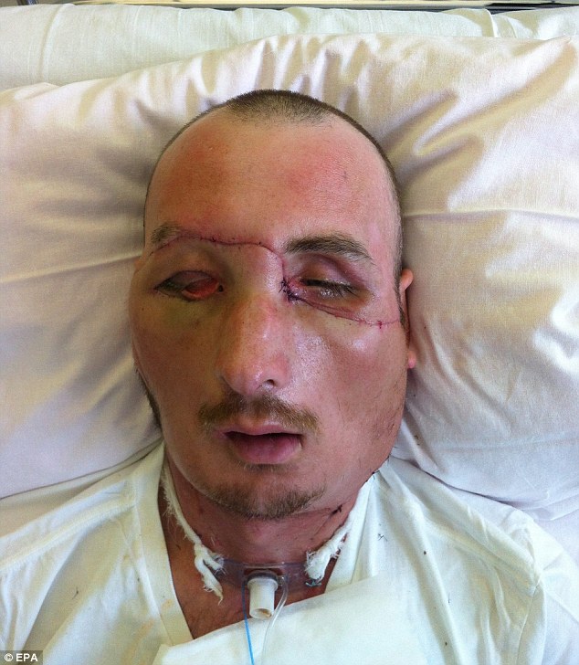 Egy lengyel férfi elveszítette arcát egy munkahelyi balesetben!