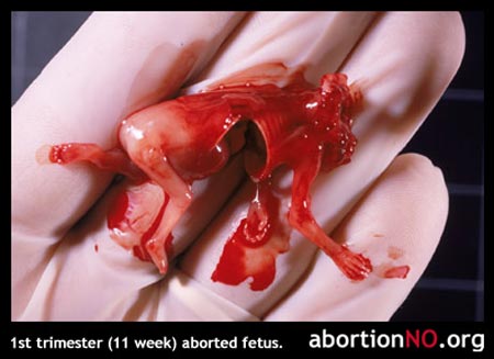 Sokkoló képek! Abortuszt végző orvosok szerint a magzat csak egy főtt hús állagú termék!
