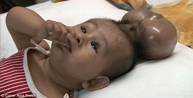 Videó! Két fejjel született az indiai kisfiú