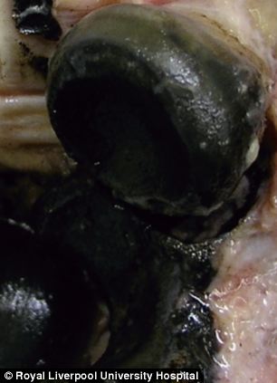 Alkaptonuria - amitől a szemek, csontok és porcok fekete színűek lesznek