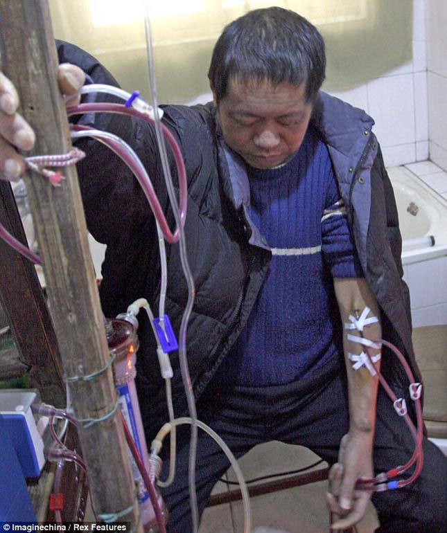 Tizenhárom éve él a kínai férfi a házilag összetákolt dialízis gépen