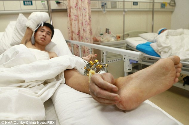 A lábához műtötték a csuklóját, hogy megmentsék az életét