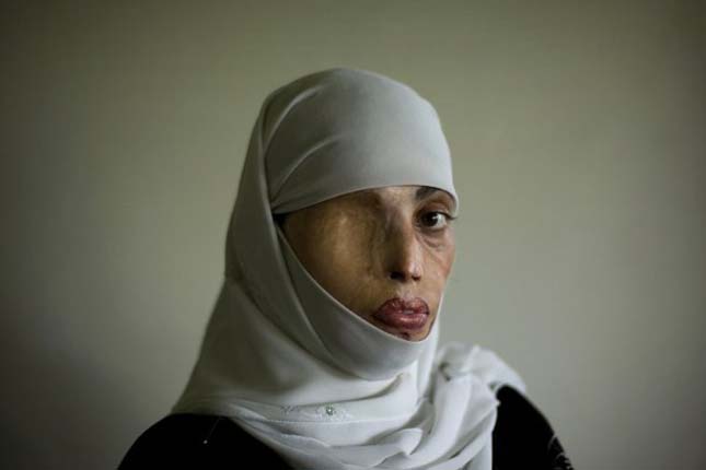 Iszlám világ női áldozatai – egy életre elcsúfított nők – sokkoló fotók