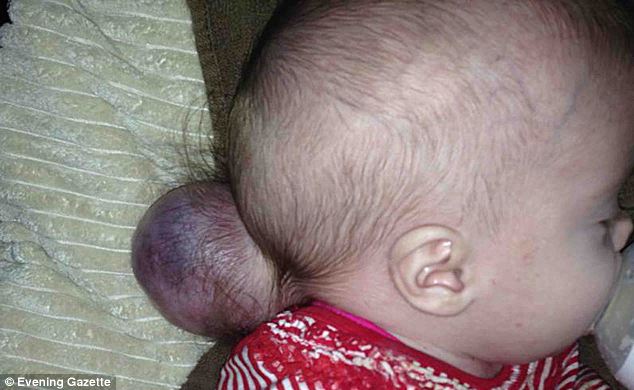 A kisbaba agyának egy része a koponyáján kívülre nőtt
