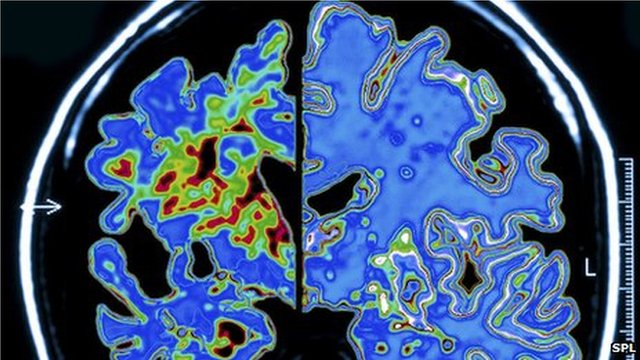 Vérvizsgálattal megállapítható a későbbi Alzheimer-kór