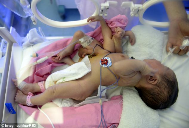 Nyolc végtaggal született egy kínai baba – sokkoló fotó