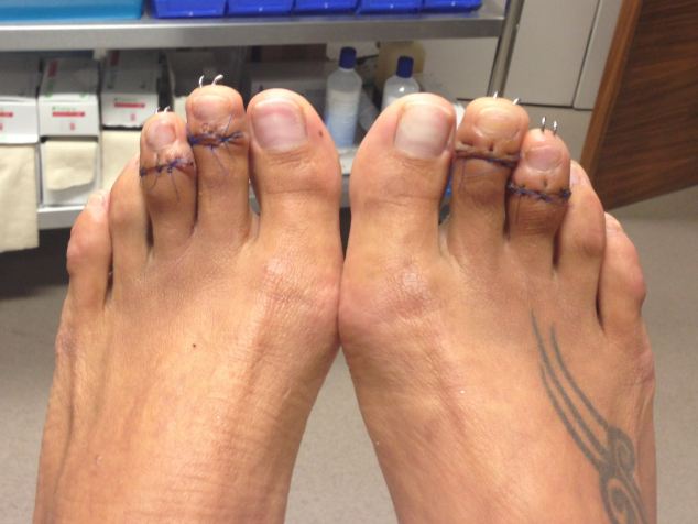 A lábujjak korrekciós műtéte - veszélyes, de egyre több nő választja 