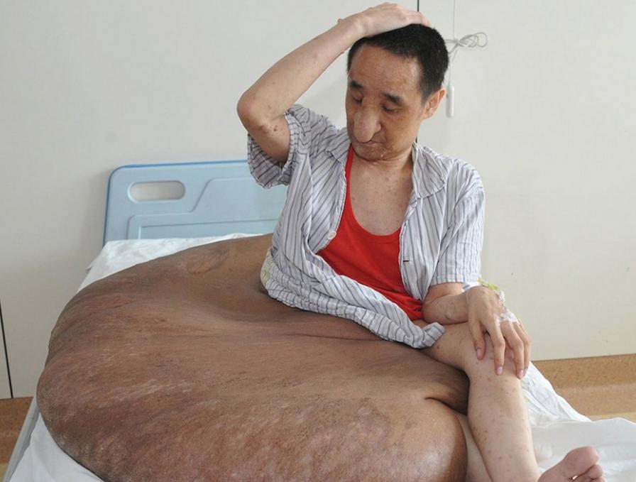 108 kilós daganat volt a férfi lábán