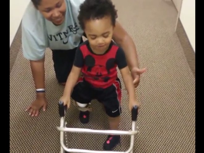 Megható pillanat – először jár az amputált lábú kisfiú! – videó