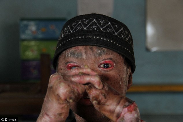 41 naponta teljesen levedli bőrét egy indonéz fiú - megrázó fotók!