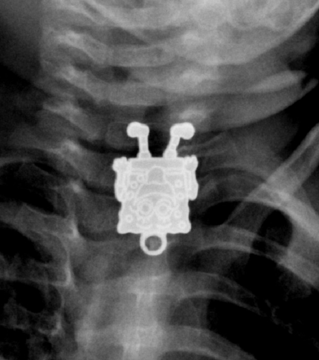 Spongyabobot látta viszont az orvos a kisbaba röntgenképén!  – fotó