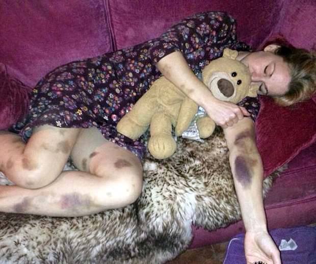 Leukémiája miatt egy éjszaka alatt véraláfutások lepték el a nő testét – megrázó fotók