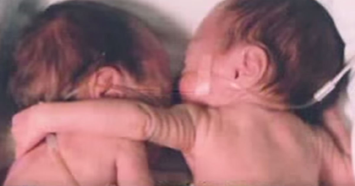 Haldokló újszülött babát ikertestvére ölelése gyógyította meg – szívszorító fotó