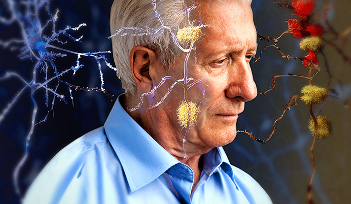 Összefüggés lehet az Alzheimer-kór és az öregedéssel kapcsolatos negatív gondolatok között