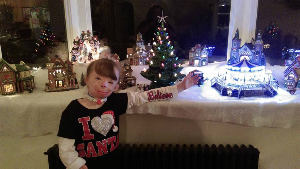 Szívszorító! Karácsonyi képeslapokat vár a súlyosan megégett 5 éves kislány