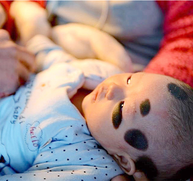 Dalmatának néz ki a 2 hónapos baba a ritka bőrbetegsége miatt