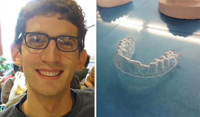 Egy diák 3D nyomtatással tökéletes fogszabályzót alkotott magának