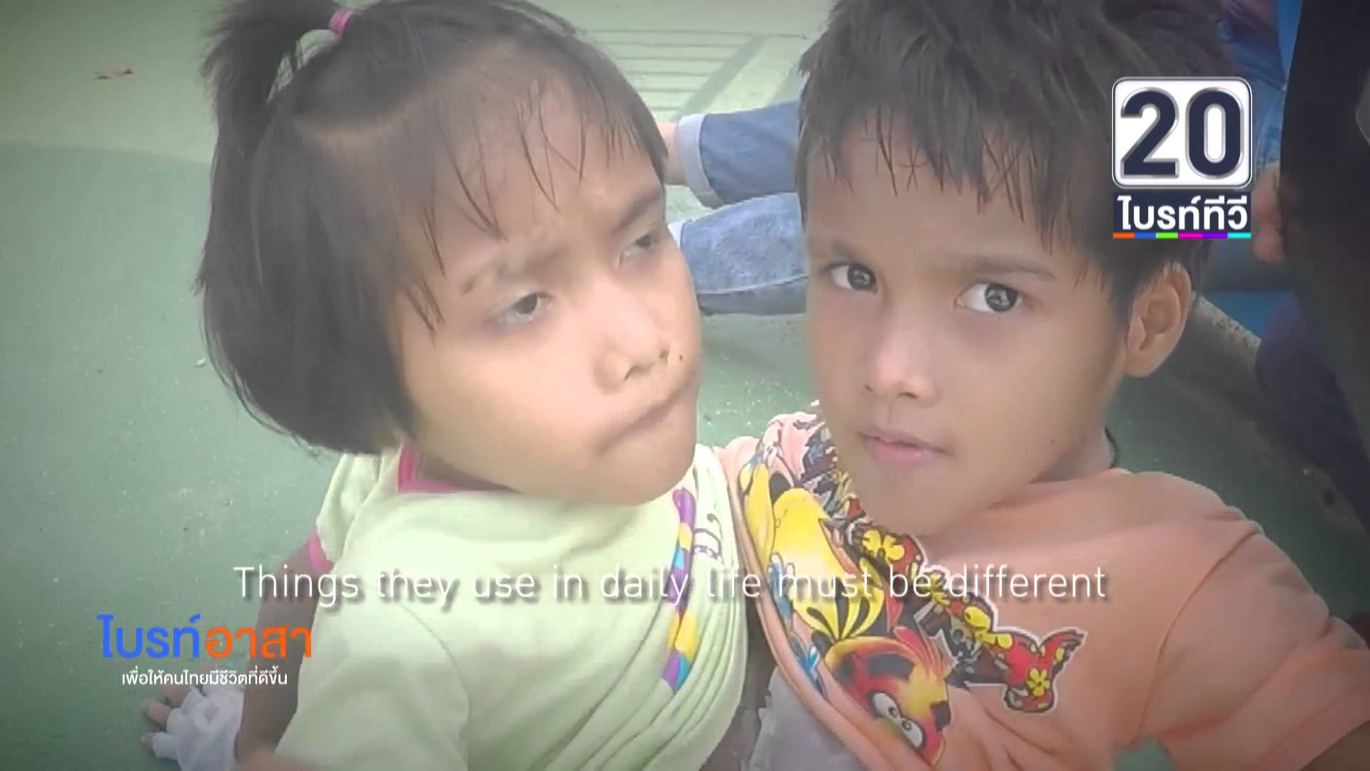 Szívszorító videó a hasuknál összenőtt 7 éves sziámi ikrekről