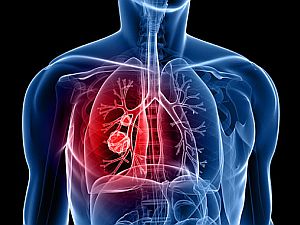 Évente tízezer új tüdőrákos beteget regisztrálnak Magyarországon