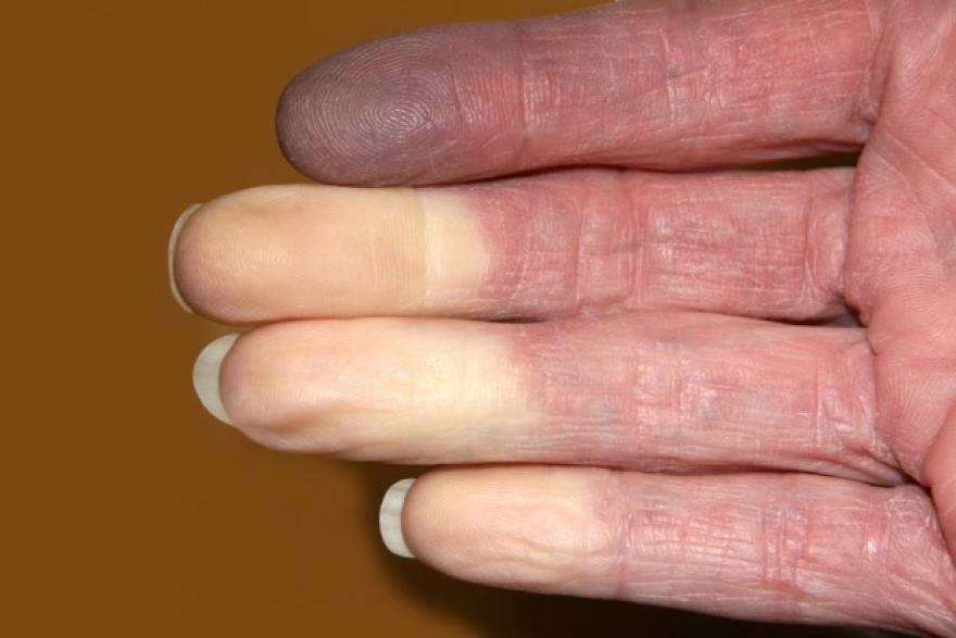Mitől fehérednek le az ujjak?