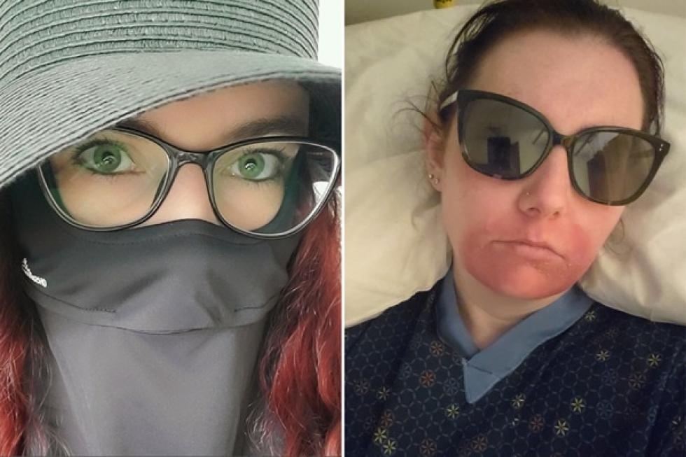 Egy percnyi napfény is halálos lehet Emily Richardsonra
