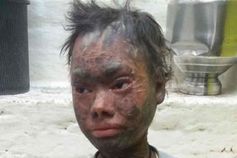 Betegsége miatt emberi kígyónak csúfolják a lányt –megrázó fotók