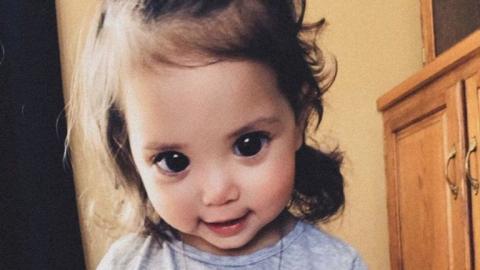 Genetikai betegség miatt óriási mangaszemei vannak a 2 éves kislánynak