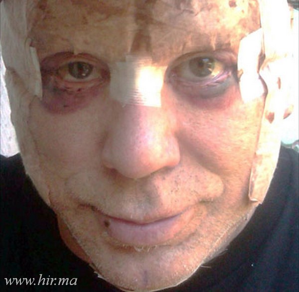 Mickey Rourke plasztikai műtét után! Sokkoló fotók!
