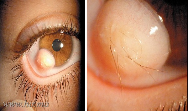 Egy férfi szemében szőrszálak nőttek ki! 