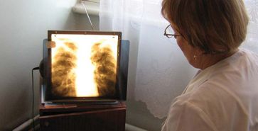 Kényszergyógykezelésre utalják a fertőző tébécés betegeket Kárpátalján