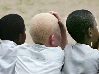 Levágták a kisfiú kezét csak azért, mert albínó volt