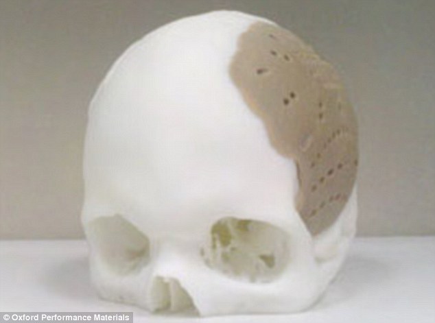 Egy beteg koponyájának 75%-át 3D nyomtatással készült implantátum alkotja