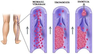 trombozis