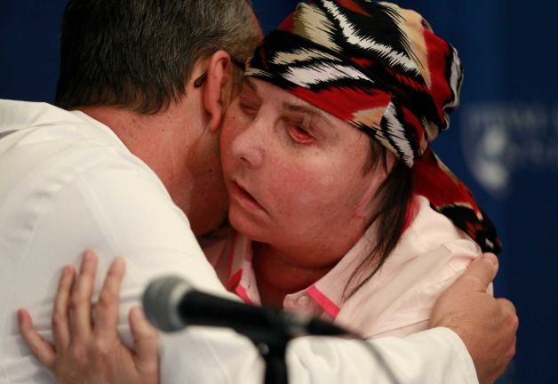 Szervdonortól kapott új arcot a lúggal leöntött nő - korábban családja sem ismerte fel