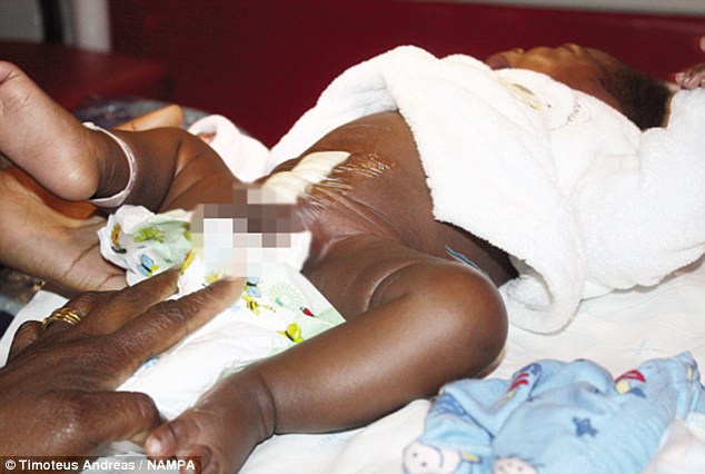 Megműtötték a négy lábbal született namíbiai csecsemőt