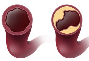 Illustration comparing a healthy coronary artery with one blocke