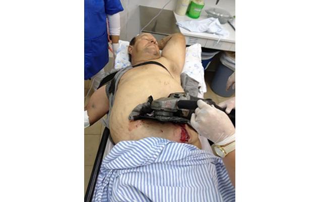 Túlélte a brazil férfi, hogy a láncfűrész a hasába fúródott