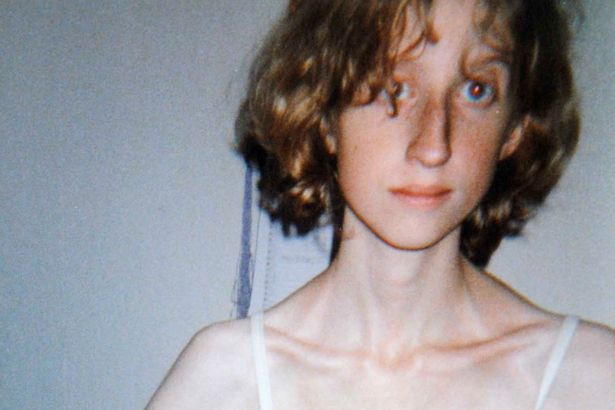 Balett miatt lett anorexiás 10 évesen - sokkoló fotó