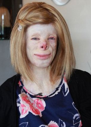 EXTRAORDINARY PEOPLE: THE GIRL WITH 90% BURNS