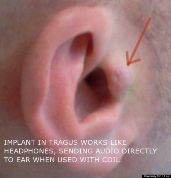 headphone-implant2-550x572
