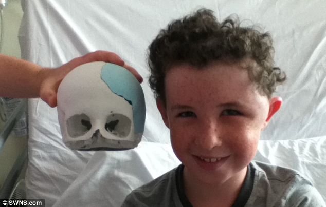 Egy arcüreggyulladás miatt fél koponyáját el kellett távolítani a kilencéves fiúnak