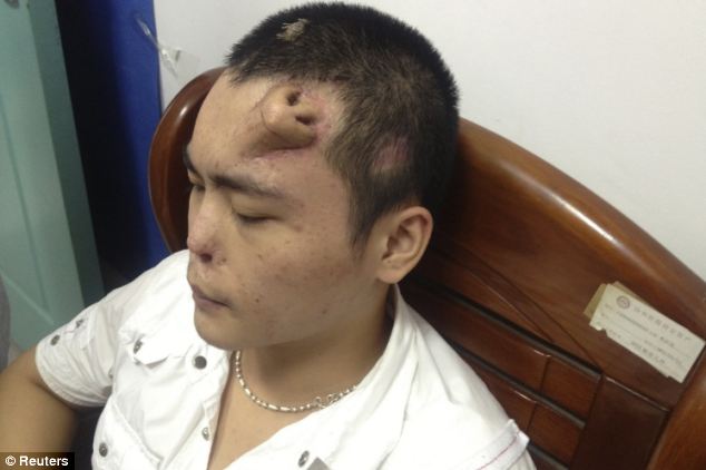 Homlokán kapott új orrot a kínai férfi