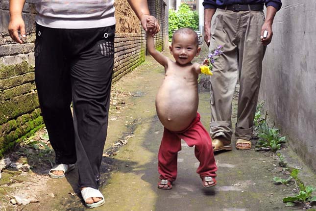 Fetus in Fetu Appears in Henan